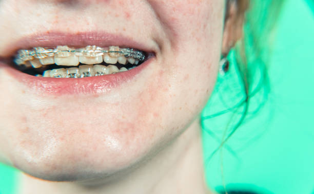 Impact of Orthodontics